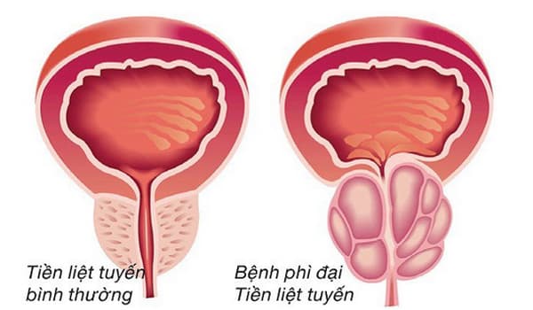 Phì đại tiền liệt tuyến là gì?